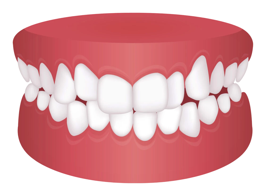 Teeth crowding